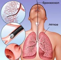 Що таке бронхоскопія та навіщо вона потрібна?
